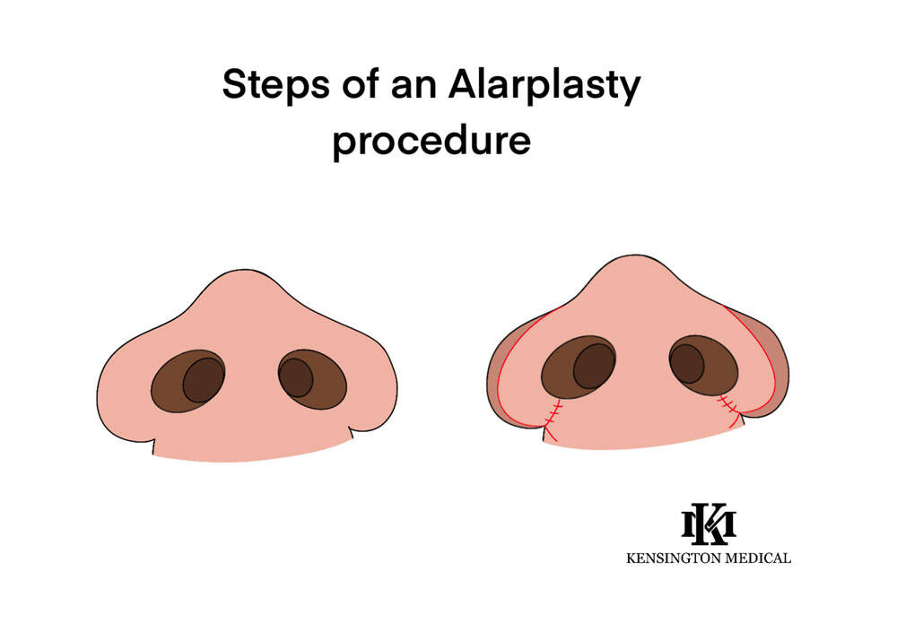 Alar Base Reduction Nostril Contouring Kensington Medical