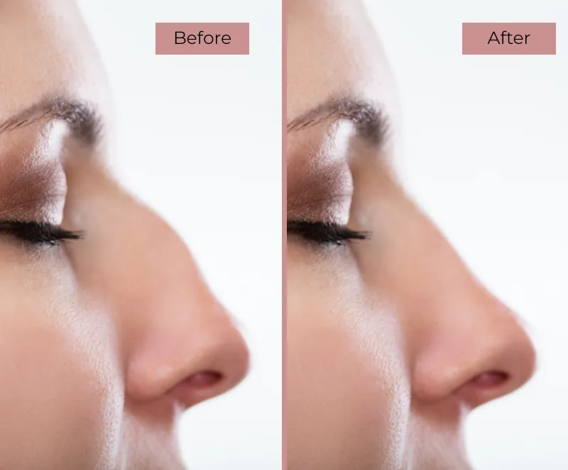 Before and After Rhinoplasty Surgery